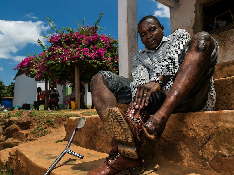 Long Limbs Prosthetics - An Interchangeable Prosthetic System for Long Stump Amputees
