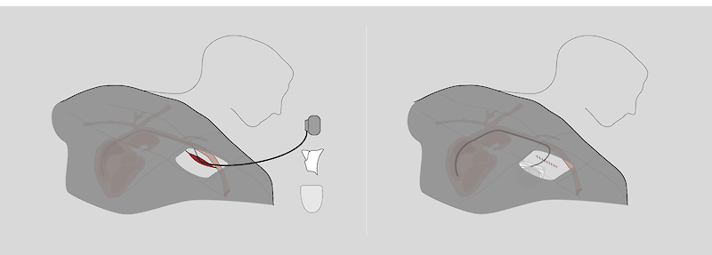 SIMPLX - Hylomate Surgical Applicator