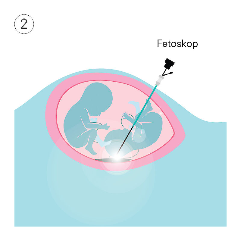 AmnioFix - Verschliessen der Fetalmembran